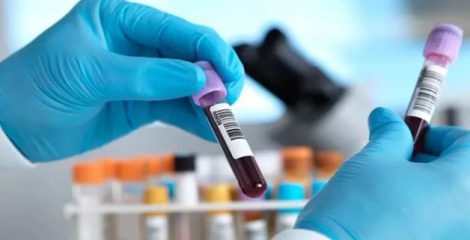 হেপাটাইটিস সি নির্মূলের পথে ইংল্যান্ড